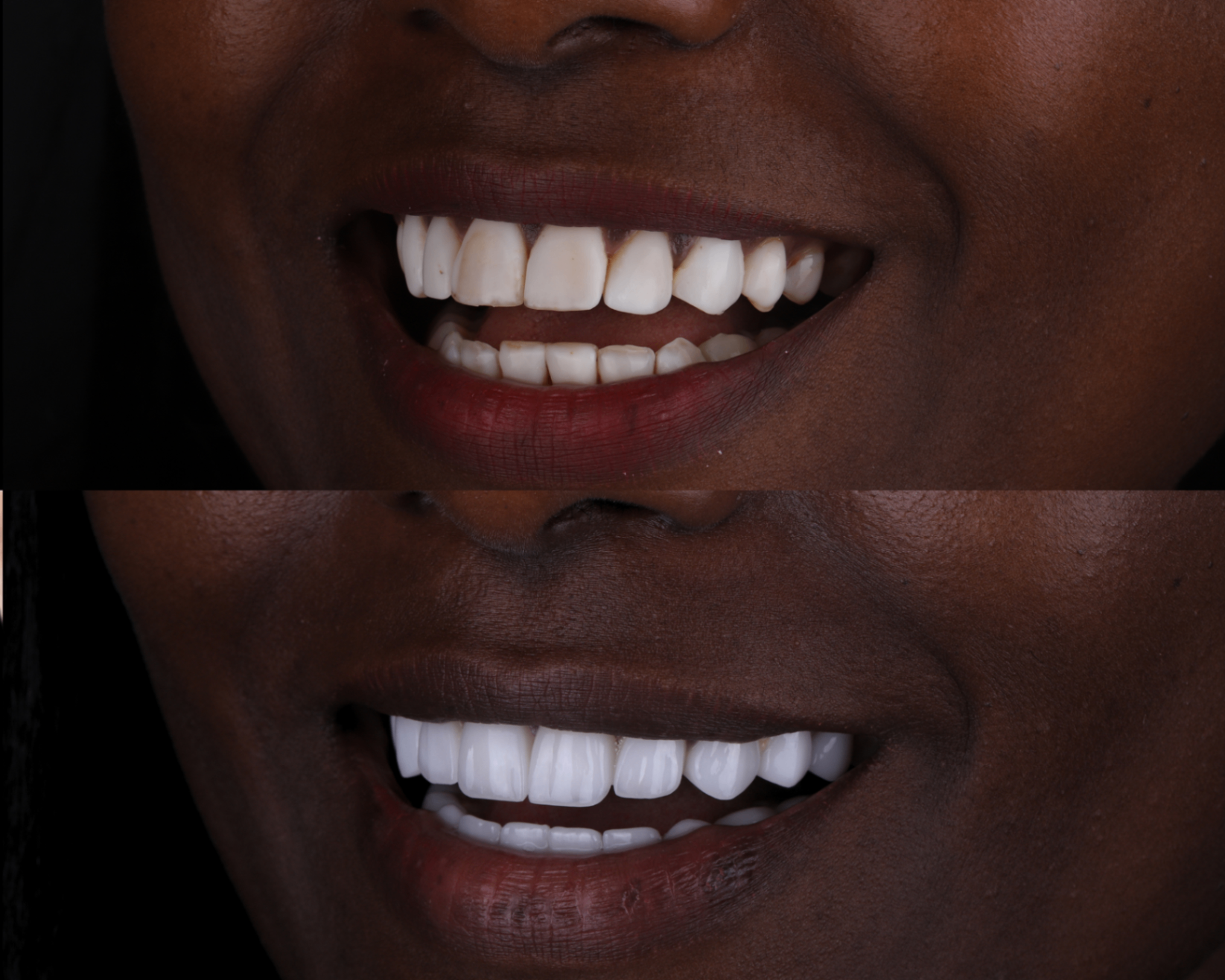 Before and after — Old composite bonding to new Emax Veneers
