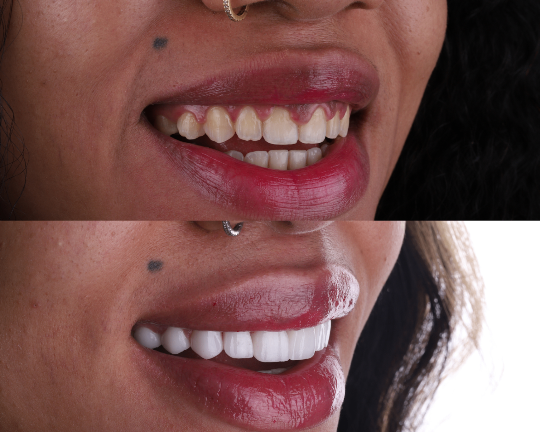 Before and after — Smile reconstruction