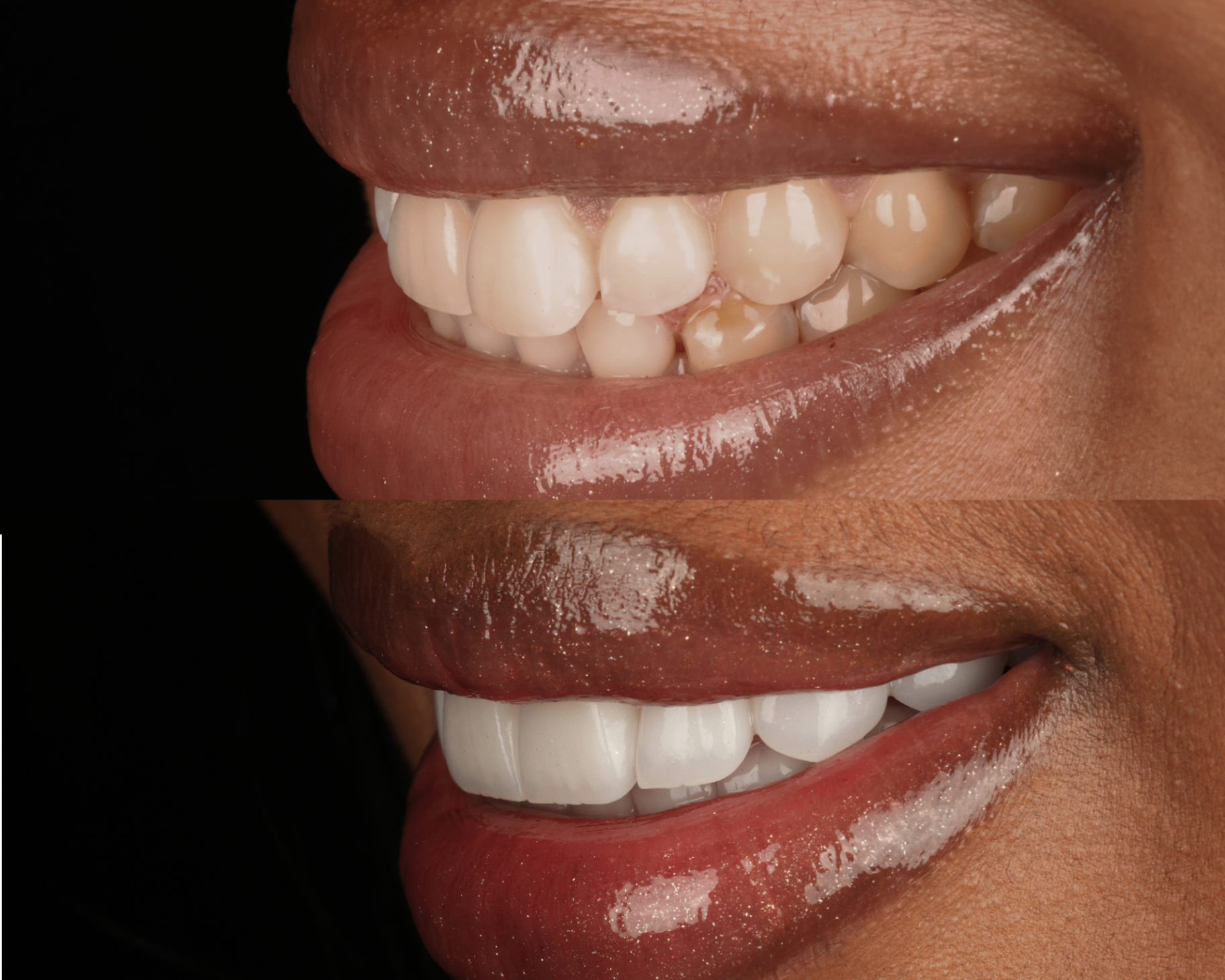 Before and after — Complete smile makeover