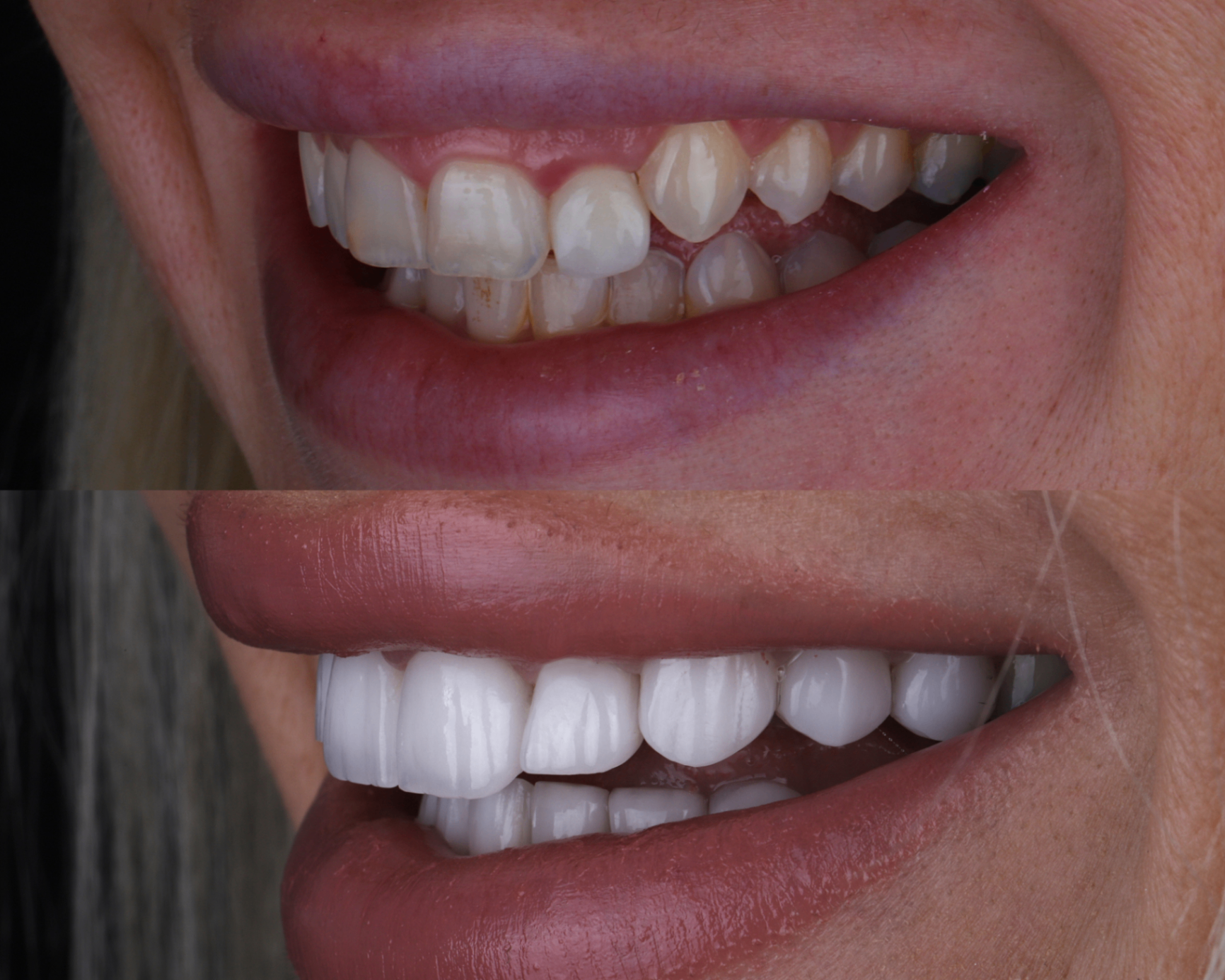 Before and after — Porcelain veneers