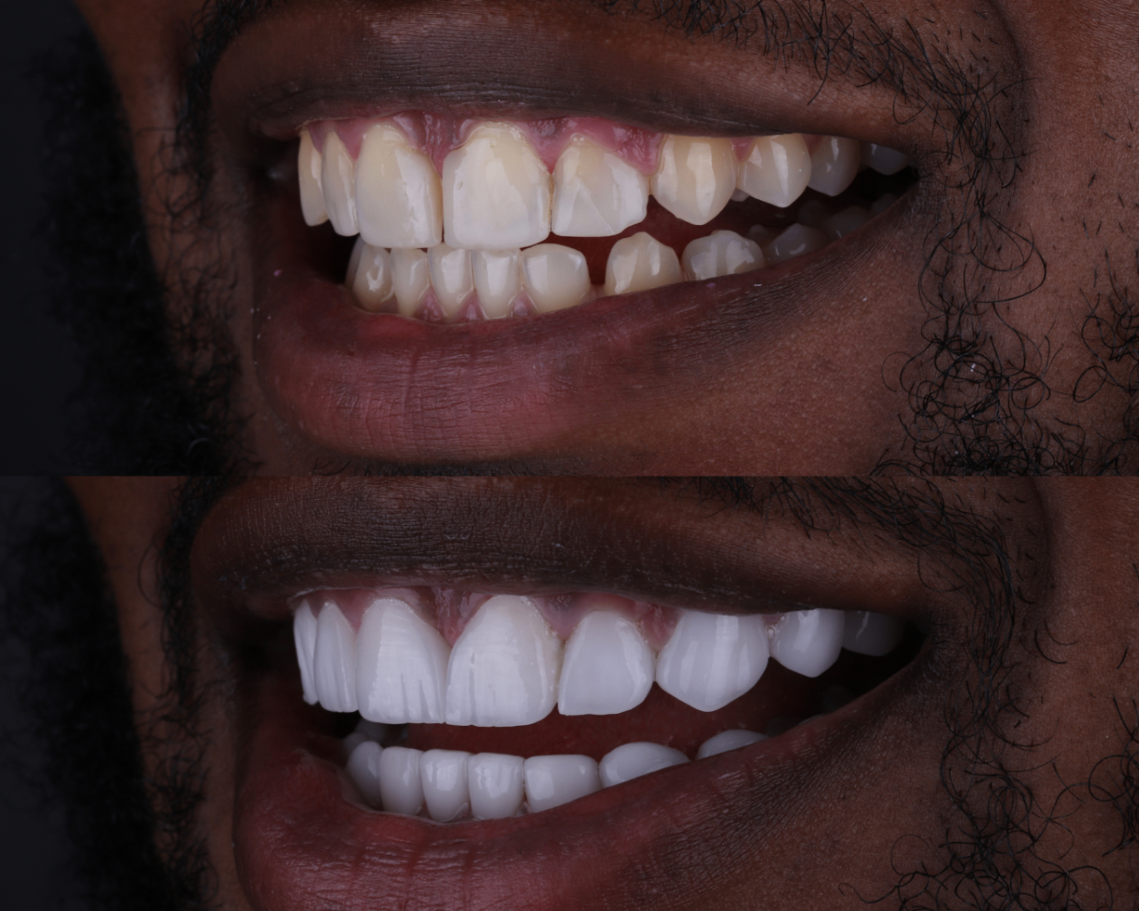 Before and after — Full veneer transformation