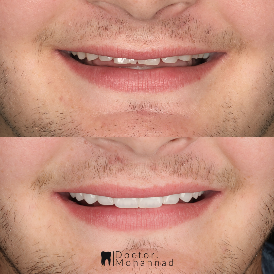 Before and after — Anterior veneers